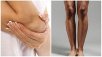  6 DIY Homemade Remedies For Dark Elbows & Knees