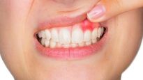 Expert Article: Diabetes And Oral Health; How Does Diabetes Affect Our Mouths?