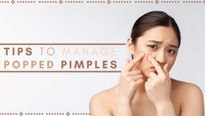 Popped That Pimple? Tips To Take Care Of It And The Surrounding Skin
