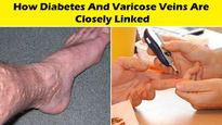 Exclusive: Expert Explains How Diabetes And Varicose Veins Are Closely Linked, Risk Factors, And Treatments 