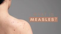 Measles Outbreak In Mumbai: Know About The Disease, Its Causes, Symptoms, Treatment And Prevention