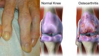 Osteoarthritis (OA): Expert Shares Signs, Causes, Symptoms And Treatments