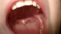 Bad Taste In Mouth: How To Fix It, Why It Indicates Multiple Health Problems