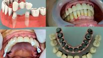  Dental Implants Vs Dentures: Which One Is Best For You To Get A Perfect Smile