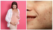 What Is Pregnancy Mask (Melasma): Ways To Manage It