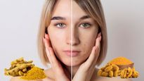 Turmeric For Acne: Try This 30-Day Remedy Step By Step