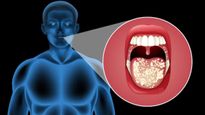 Oral Cancer: Early Detection, Diagnosis And Staging