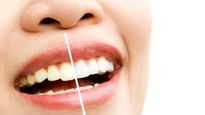 Ashamed Of Your Yellow Teeth? Check Out These Expert Approved Home Remedies To Get Sparkling White Teeth