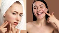 Why Can't We Resist Popping Pimples? Let's Find Out Why We Derive So Much Pleasure From Them!