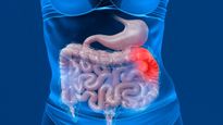 Detecting Bowel Cancer: 10 Signs Of This Silent Killer To Watch Out For And Seek Medical Attention 