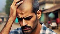 A ‘Hair-Raising’ Crisis In Maharashtra : The ‘Bald’ Truth Behind the Epidemic