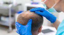 Hair Transplant Aftercare: What Happens If You Don’t Maintain Hair After a Transplant?