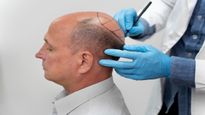 Pain, Downtime, and Recovery After Hair Transplant Surgery: What Patients Really Experience