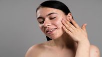 Struggling With Oily Skin This Summer? Simple Tips to Keep Shine Under Control
