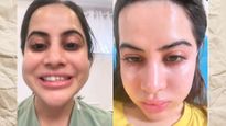 Uorfi Javed Reveals Swollen Face Was Caused By Cat Allergy And Stress, Not Fillers