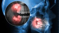 Wisdom Teeth Myths Dentists Hear Constantly  And What You Really Need To Know