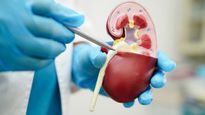 Kidney Transplant Rejection Can Be Silent. Here Is How Doctors Catch It