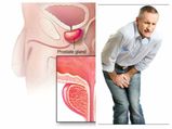 ಪ್ರೊಸ್ಟೇಟ್‌ ಕ್ಯಾನ್ಸರ್‌ ಬಗ್ಗೆ ಇರುವ ಈ ತಪ್ಪು ಕಲ್ಪನೆಯಿಂದಲೇ ಅಪಾಯ ಹೆಚ್ಚುತ್ತಿದೆ!