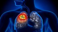 ನವೆಂಬರ್‌ನಲ್ಲಿ ಶ್ವಾಸಕೋಶ ಕ್ಯಾನ್ಸರ್ ಜಾಗೃತಿ: ಇದೊಂದು ಅಪಾಯಕಾರಿ ಕ್ಯಾನ್ಸರ್ ಏಕೆ?