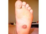 07 19 Nipple Is Found On Foot Aid0032.html