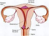 ഗര്‍ഭാശയഗള കാന്‍സര്‍ ലക്ഷണവും ചികിത്സയും