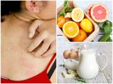 Foods You Should Not Eat If You Suffer From Psoriasis