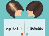 കഷണ്ടിയില്ല ഇനി; ഷാമ്പൂവിനൊപ്പം മൂന്ന് കൂട്ടുകള്‍
