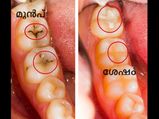 ദന്തഡോക്ടറില്ലാതെ തന്നെ പല്ലിലെ പോടിന് വിട