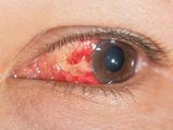 കണ്ണിലെ ചുവപ്പ് അപകടമാകുമ്പോള്‍