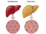 ഫാറ്റി ലിവറിന് പരിഹാരങ്ങളിതാ...