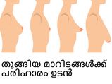 തൂങ്ങിയ മാറിടത്തിന് പരിഹാരം വേണോ?