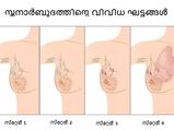 സ്തനങ്ങളിലെ ഈ മാറ്റങ്ങള്‍ അവഗണിയ്ക്കരുത്