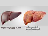 ഈ ലക്ഷണങ്ങള്‍ കണ്ടാല്‍ ഉറപ്പിക്കാം കരള്‍രോഗം