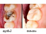 പല്ലിലെ പോടിനെ മാറ്റാന്‍ ഫലപ്രദം ഈ വഴികള്‍
