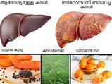 ലിവര്‍ സിറോസിസ് 100% വീട്ടില്‍ തന്നെ മാറ്റാം