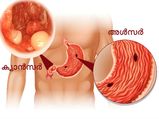 അള്‍സര്‍ ക്യാന്‍സര്‍ ആവാന്‍ ഇത്രയും സമയം മതി