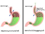 അസിഡിറ്റി വില്ലനാകുമ്പോള്‍ രക്ഷ ഭക്ഷണം തന്നെ