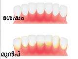 പല്ലിലെ ഈ മഞ്ഞ ആവരണം നീക്കാം