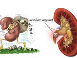 കിഡ്‌നി സ്‌റ്റോണ്‍ മാറ്റാന്‍ വെറും 7 ദിവസം