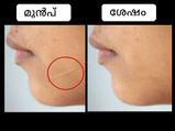 മുഖത്തെ മുറിപ്പാടിന്‌ നിമിഷപരിഹാരം