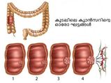 കുടലിലെ ക്യാന്‍സര്‍; സൂക്ഷിക്കുക ഈ ലക്ഷണങ്ങള്‍