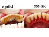 പല്ലിലടിഞ്ഞ അഴുക്കും മഞ്ഞപ്പും തനിയെ നീക്കാം