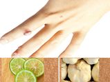 Home Remedy Using Garlic Lemon Treat Warts
