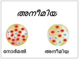 കുട്ടികളിലെ വിളര്‍ച്ചയുടെ ലക്ഷണങ്ങള്‍