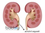 മൂത്രത്തില്‍ കല്ലിനെ തുടക്കത്തില്‍ തിരിച്ചറിയാം