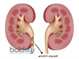 കിഡ്‌നി സ്റ്റോണ്‍ പെട്ടെന്നലിയിക്കും ഒറ്റമൂലി