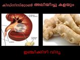 കിഡ്‌നി സ്‌റ്റോണ്‍ ഇല്ലാതാക്കും ഇഞ്ചിക്കിഴി
