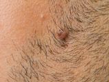 Remedies To Remove Pubic Hair Naturally