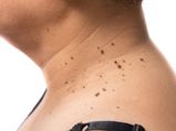 T Home Remedies To Remove Skin Tags