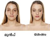 മുഖത്തെ കരുവാളിപ്പിന് സ്ഥിര പരിഹാരം